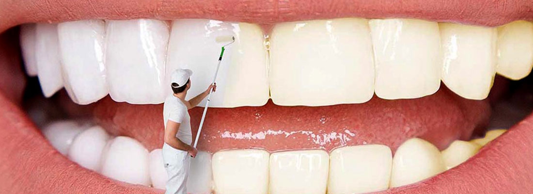 چگونه ماندگاری بلیچینگ دندان را افزایش دهیم؟