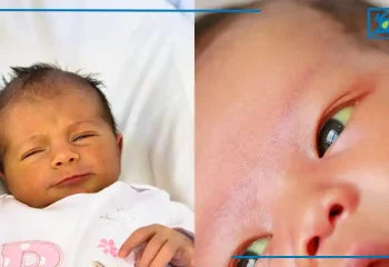 درمان فوری زردی نوزاد در خانه + روش های طب سنتی